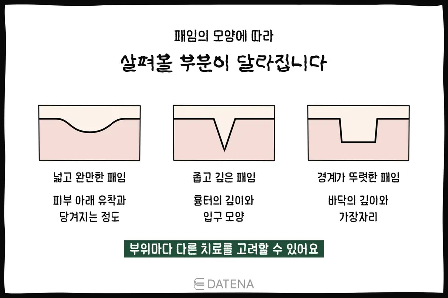 以皮膚剖面比較寬而平緩的凹陷、窄而深的凹陷、邊界分明的凹陷的插圖