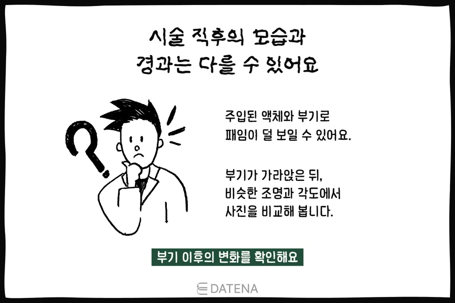 說明療程剛結束時因腫脹與注入液體，凹陷可能看起來較不明顯的人物插圖