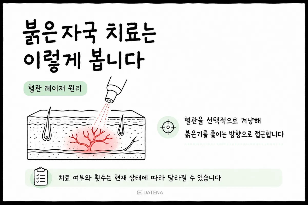 針對痘痘紅印擴張血管的血管雷射原理圖