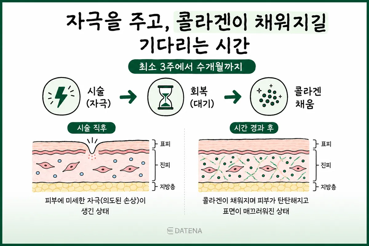 療程後皮膚從受刺激、恢復到膠原蛋白填補過程的皮膚剖面示意圖