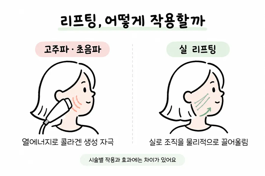 以臉部示意圖比較電波・超音波拉提與埋線拉提的作用方式