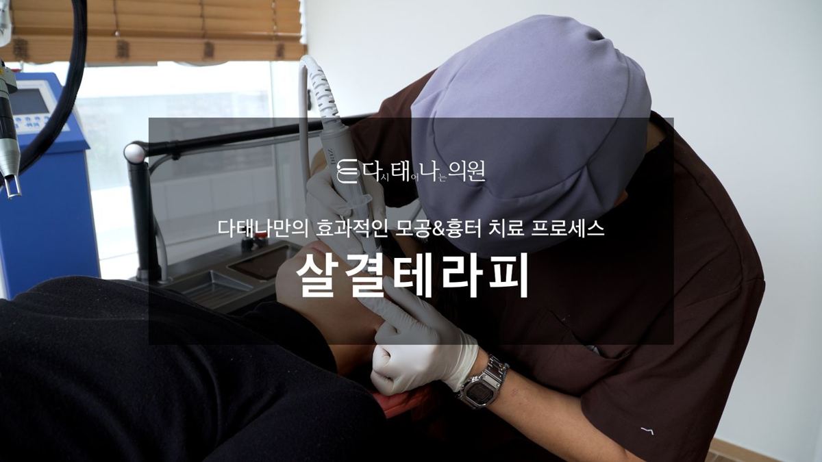 痘坑治療 8