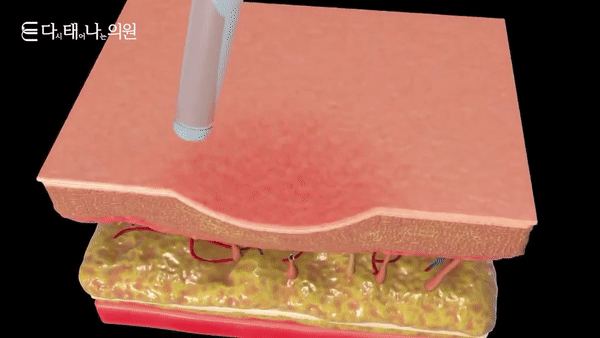 痘坑治療 22